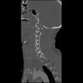 Cervical spine fractures with vertebral artery dissection (Radiopaedia 32135-33078 Sagittal bone window 27).jpg