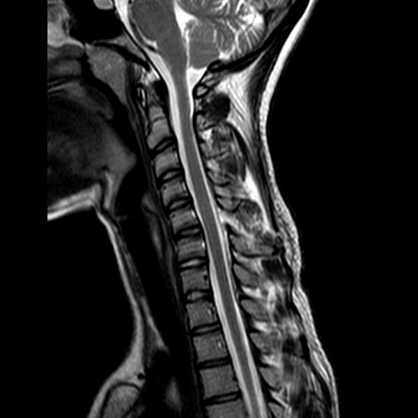 File:Cervical spine posterior ligamentous complex rupture (Radiopaedia 63486-72103 Sagittal T2 6).jpg