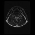 Cervical vertebrae metastasis (Radiopaedia 78814-91667 Axial T2 10).png