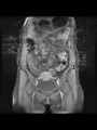 Cesarean section scar endometrioma (Radiopaedia 56569-63297 Coronal STIR 10).jpg