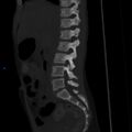 Chance fracture with duodenal and pancreatic lacerations (Radiopaedia 43477-50042 Sagittal bone window 16).jpg