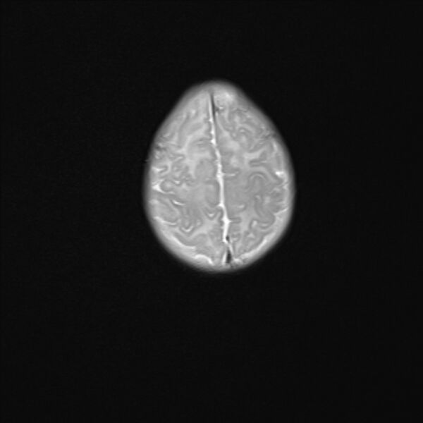 File:Chiari III malformation with occipital encephalocele (Radiopaedia 79446-92559 Axial T2 22).jpg