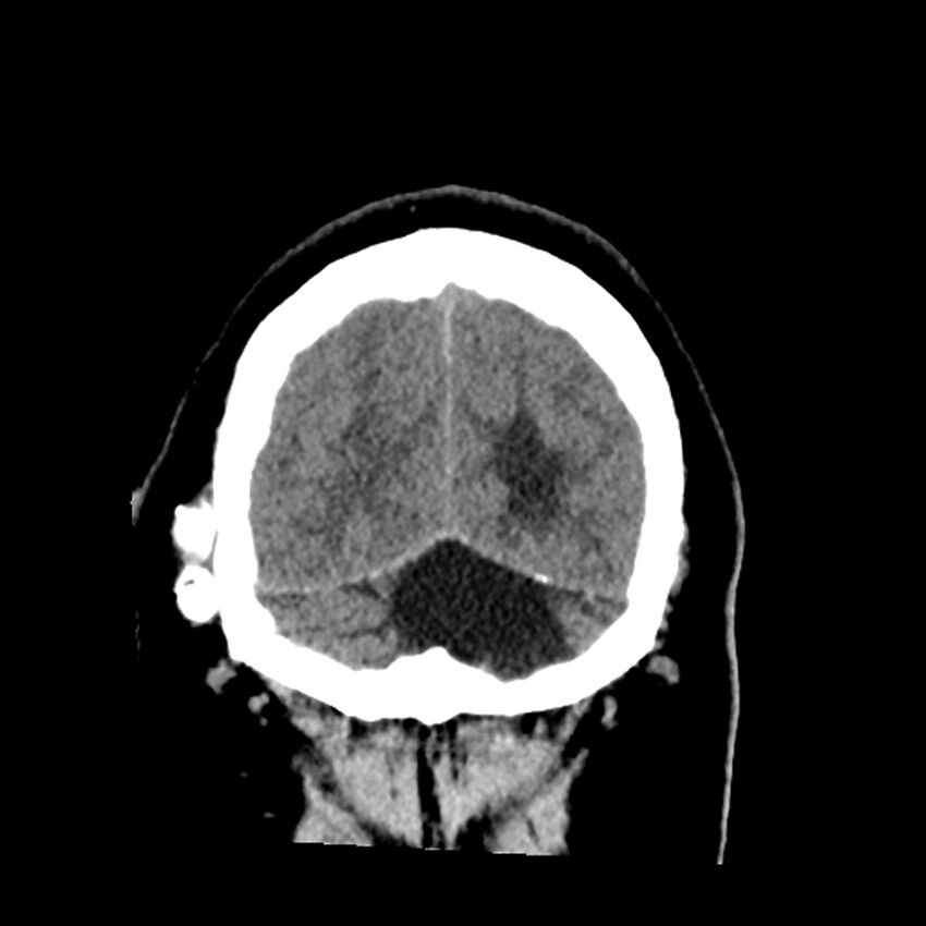 Chiasmatic-hypothalamic juvenile pilocytic astrocytoma (Radiopaedia 78533-91237 Coronal non-contrast 61).jpg