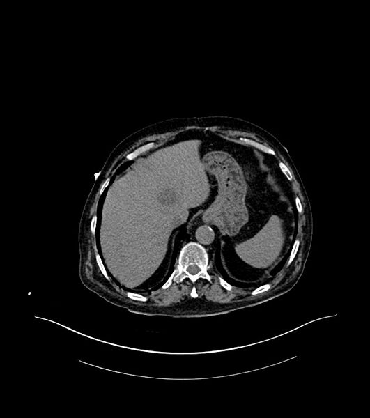 File:Cholangiocarcinoma with cerebral metastases (Radiopaedia 83519-98629 Axial non-contrast 15).jpg
