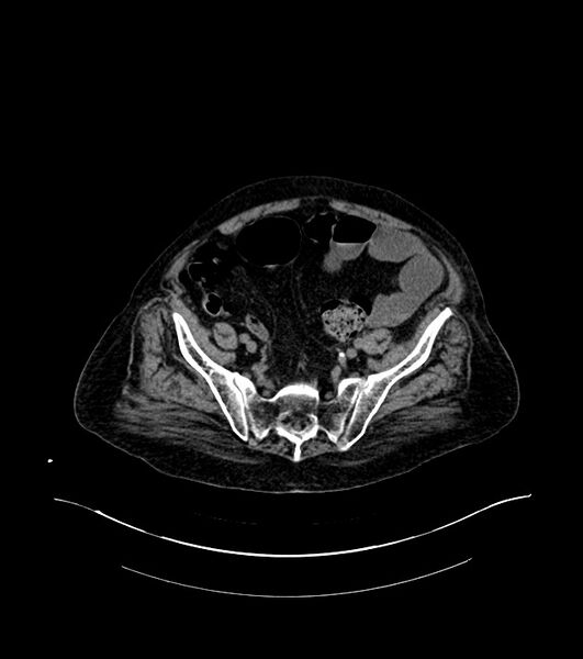 File:Cholangiocarcinoma with cerebral metastases (Radiopaedia 83519-98629 Axial non-contrast 98).jpg