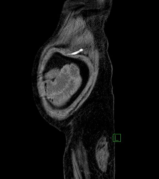 File:Cholangiocarcinoma with cerebral metastases (Radiopaedia 83519-98629 F 12).jpg