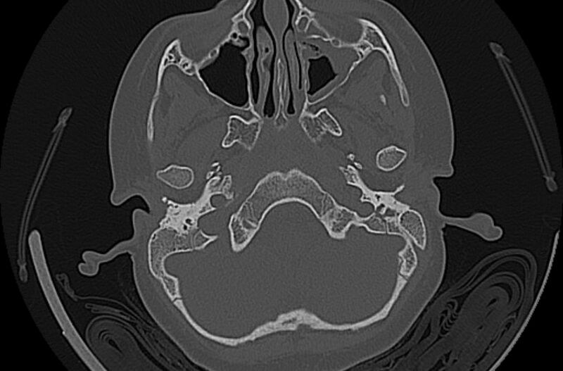 File:Cholesteatoma (Radiopaedia 73023-83750 Axial bone window 9).jpg