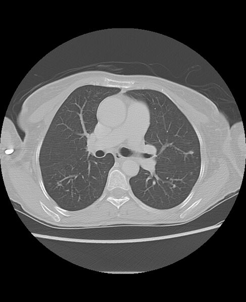 File:Chondrosarcoma (Radiopaedia 79427-92532 Axial lung window 25).jpg