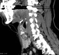 Chondrosarcoma - larynx (Radiopaedia 4588-6698 C 1).jpg