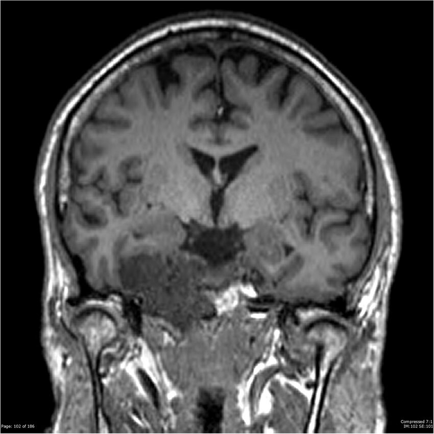 Chondrosarcoma of skull base- grade II (Radiopaedia 40948-43654 Coronal T1 23).jpg