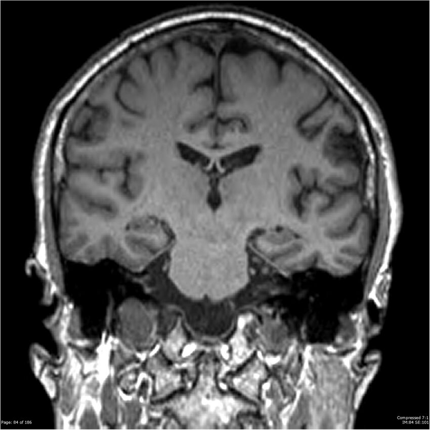 Chondrosarcoma of skull base- grade II (Radiopaedia 40948-43654 Coronal T1 5).jpg