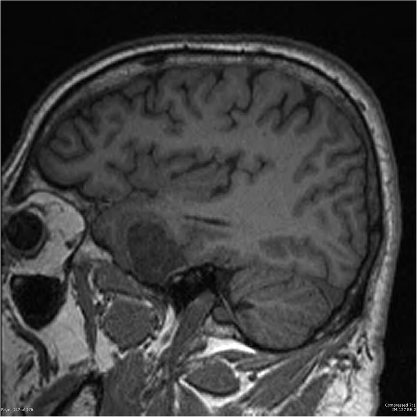 Chondrosarcoma of skull base- grade II (Radiopaedia 40948-43654 Sagittal T1 50).jpg