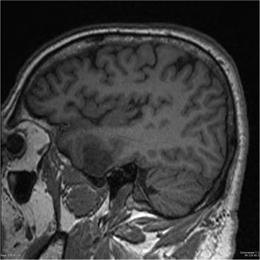 Chondrosarcoma of skull base- grade II (Radiopaedia 40948-43654 Sagittal T1 52).jpg