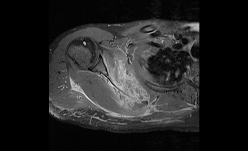 File:Choriocarcinoma in the shoulder (Radiopaedia 28603-28861 Axial T1 C+ fat sat 12).jpg