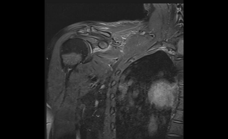 File:Choriocarcinoma in the shoulder (Radiopaedia 28603-28861 Coronal PD FS 7).jpg