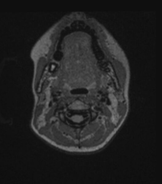 File:Choroid plexus carcinoma (Radiopaedia 91013-108553 Axial FLAIR C+ 40).jpg