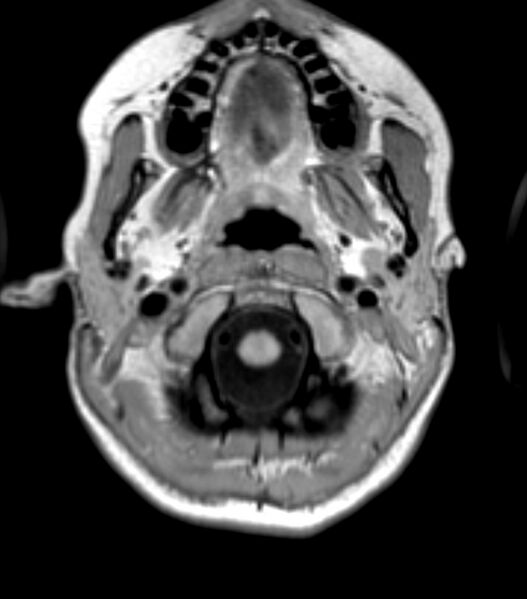 File:Choroid plexus carcinoma (Radiopaedia 91013-108553 Axial T1 27).jpg