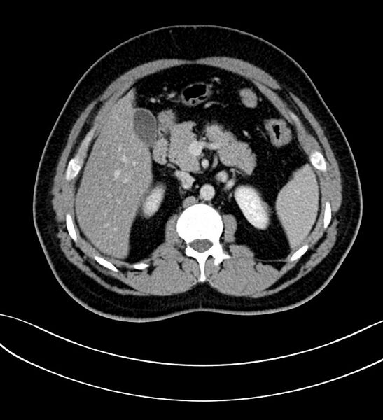 File:Chromophobe renal cell carcinoma (Radiopaedia 84286-99573 G 23).jpg