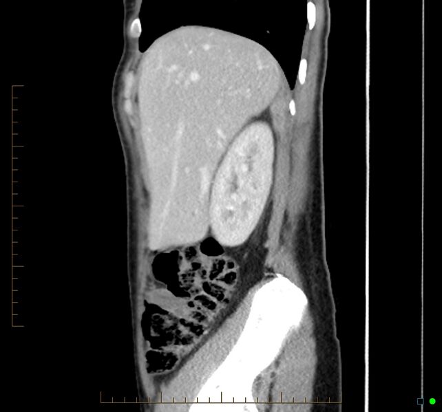 File:Chronic abscess due to "dropped" appendicoliths following appendectomy for perforated appendix (Radiopaedia 58805-66344 D 43).jpg