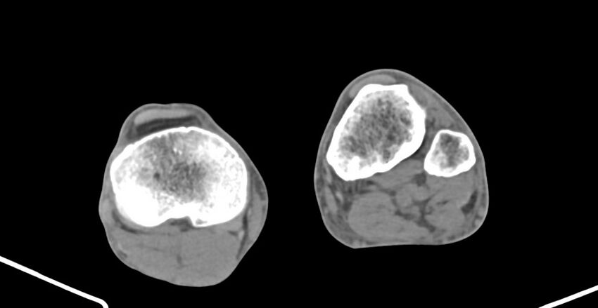 Chronic osteomyelitis (with sequestrum) (Radiopaedia 74813-85822 D 200).jpg