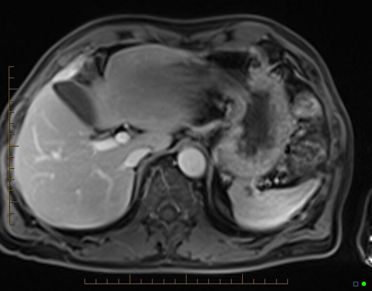 File:Chronic pancreatitis (Radiopaedia 17014-16716 Axial T1 C+ fat sat 15).jpg