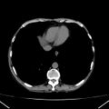 Chronic pancreatitis (Radiopaedia 23132-23172 Axial non-contrast 2).jpg
