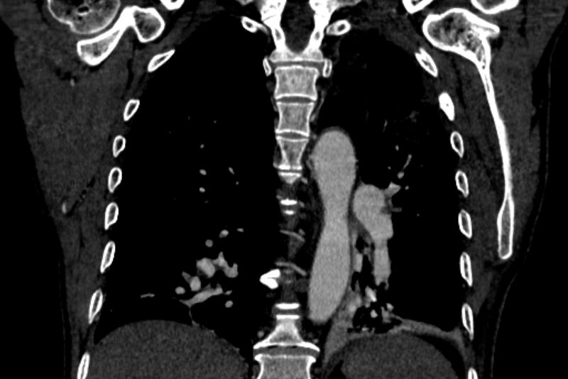 File:Chronic pulmonary embolism with bubbly consolidation (Radiopaedia 91248-108850 B 98).jpg