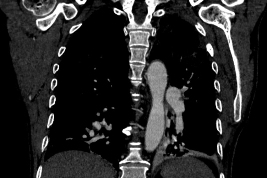 Chronic pulmonary embolism with bubbly consolidation (Radiopaedia 91248-108850 B 98).jpg