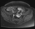 Class II Mullerian duct anomaly- unicornuate uterus with rudimentary horn and non-communicating cavity (Radiopaedia 39441-41755 Axial T1 fat sat 17).jpg