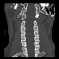 Clay-shoveler fracture (Radiopaedia 22568-22590 Coronal bone window 18).jpg