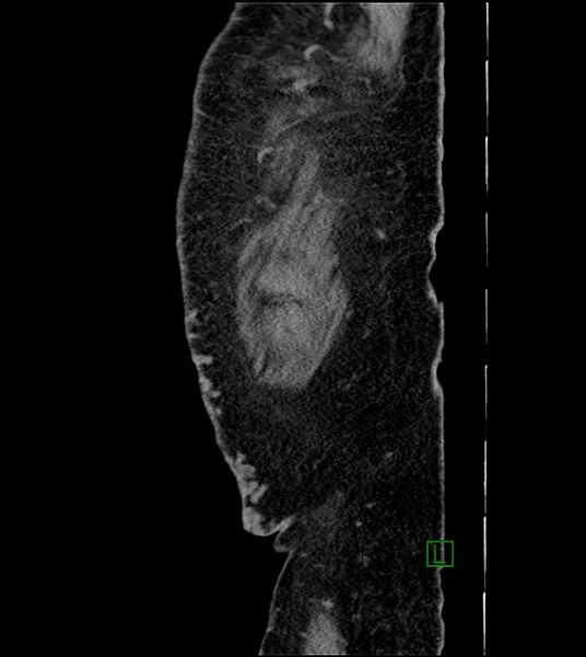 File:Closed-loop small bowel obstruction-internal hernia (Radiopaedia 78439-91096 C 14).jpg