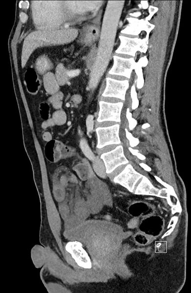 File:Closed loop small bowel obstruction - internal hernia (Radiopaedia 57806-64778 C 53).jpg