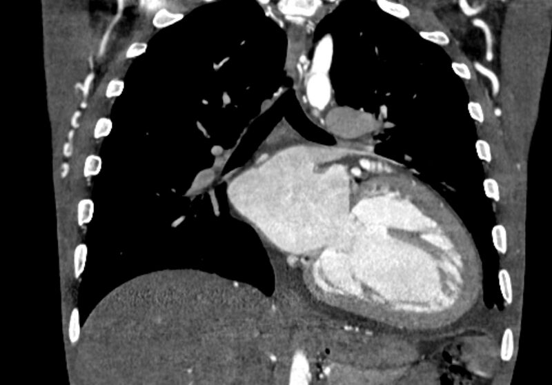 File:Coarctation of aorta with aortic valve stenosis (Radiopaedia 70463-80574 C 135).jpg