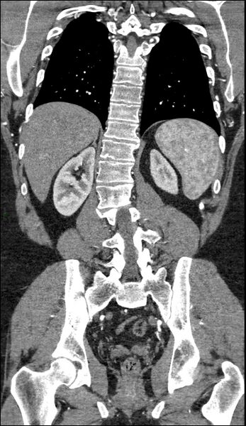 File:Coarctation of the aorta (Radiopaedia 74632-88521 B 180).jpg