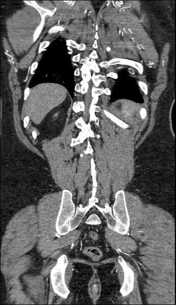 File:Coarctation of the aorta (Radiopaedia 74632-88521 B 212).jpg