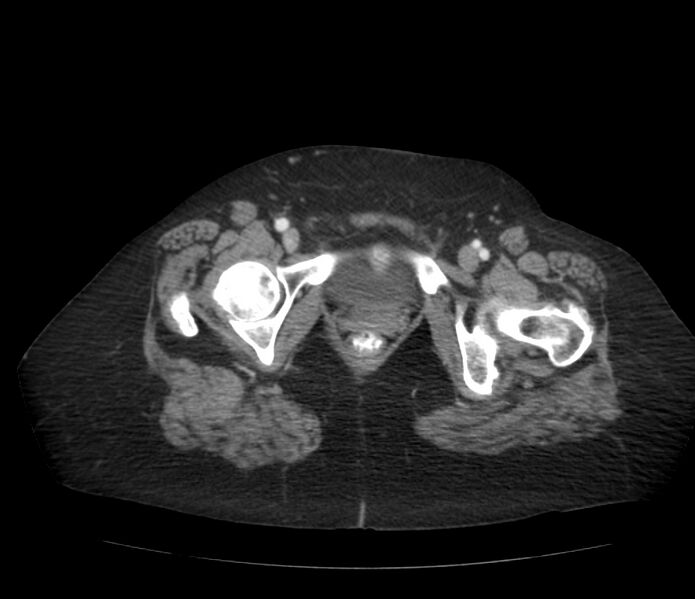 File:Colonic diverticulosis (Radiopaedia 22934-22957 A 74).jpg