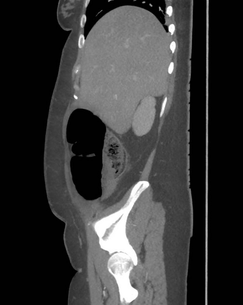 File:Colonic pseudo-obstruction (Radiopaedia 79752-92980 C 20).png