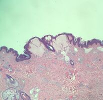 Lymphangioma circumscriptum/pathology