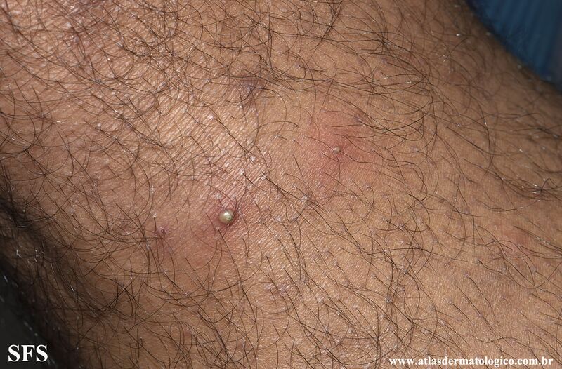 File:Folliculitis (Dermatology Atlas 13).jpg