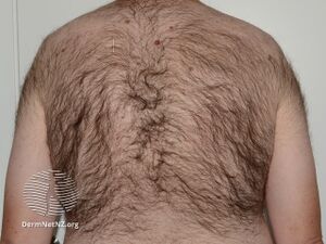 Hypertrichosis (DermNet NZ hair-nails-sweat-xs-hair-5).jpg