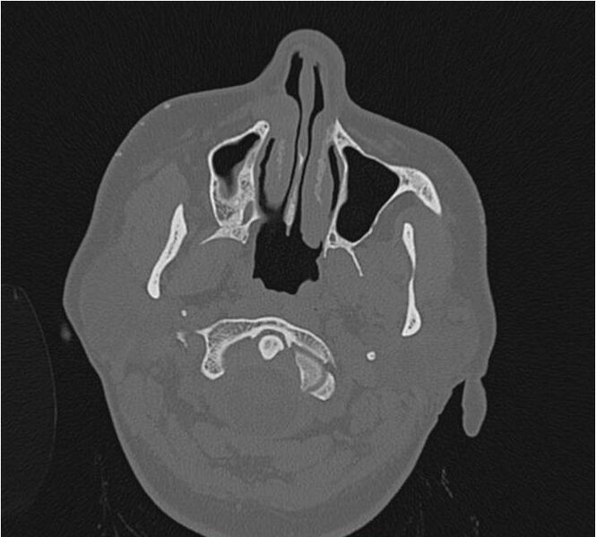 File:Nasolabial cyst (Radiopaedia 25322-25580 Axial bone window 7).jpg