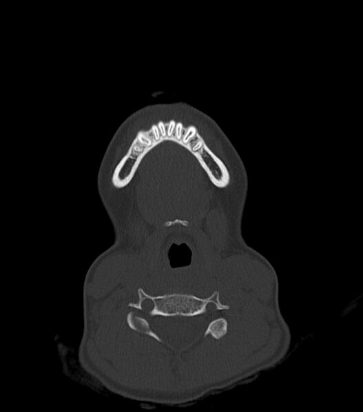 File:Nasoorbitoethmoid fracture (Radiopaedia 90044-107205 Axial bone window 20).jpg
