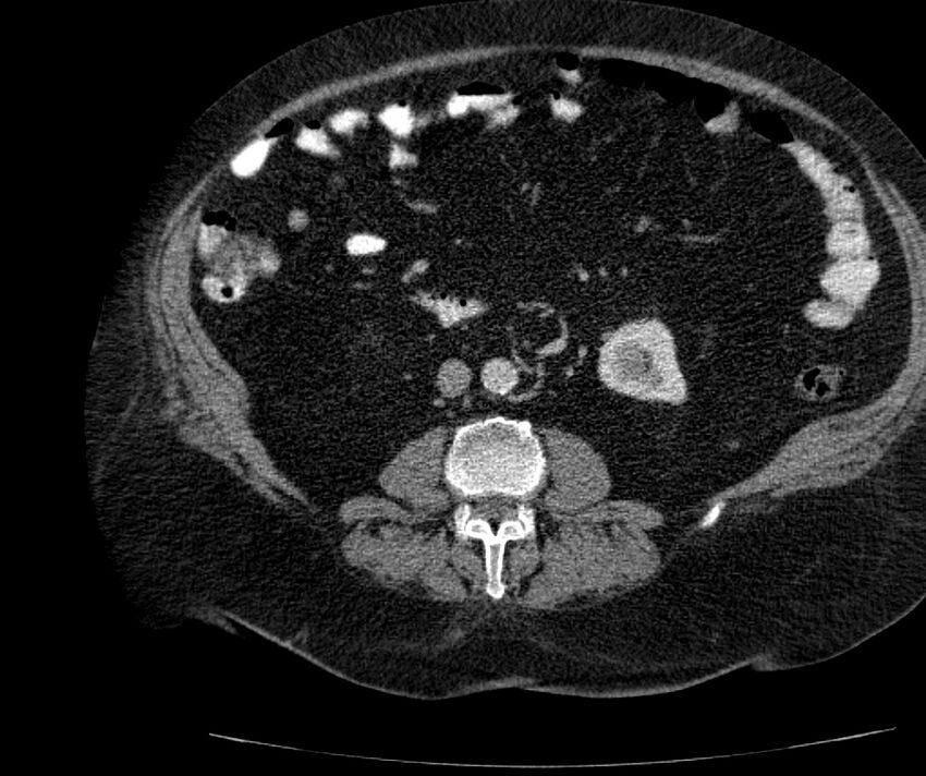 Nephroptosis with inguinal hernia containing perirenal fat (Radiopaedia 56632-63391 C 179).jpg