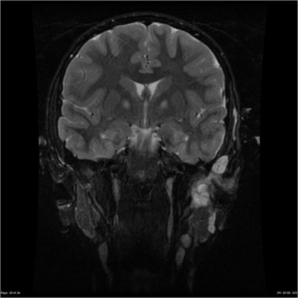 File:Neurofibromatosis type 1 (Radiopaedia 22541-22564 Coronal T2 fat sat 11).jpg
