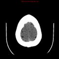 Neuroglial cyst (Radiopaedia 10713-11185 Axial non-contrast 5).jpg