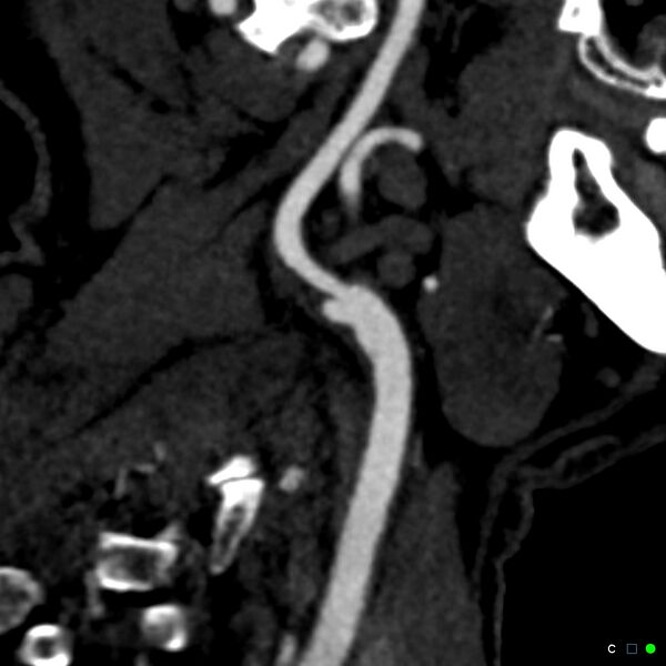 File:Non-occlusive intraluminal internal carotid artery thrombus (Radiopaedia 37751-39658 C 19).jpg
