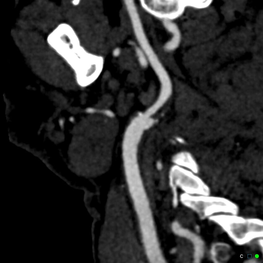 Non-occlusive intraluminal internal carotid artery thrombus (Radiopaedia 37751-39658 C 52).jpg