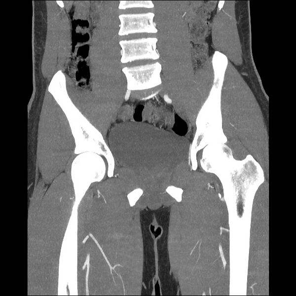 File:Normal CT angiogram of pelvis (Radiopaedia 45390-49430 B 25).jpg