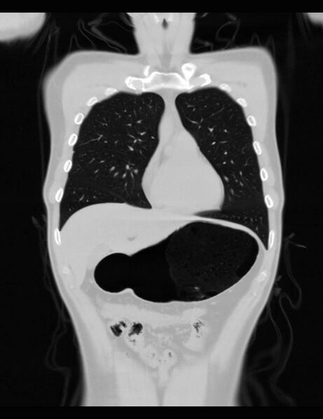 File:Normal CT virtual gastroscopy (Radiopaedia 29960-30501 F 16).jpg
