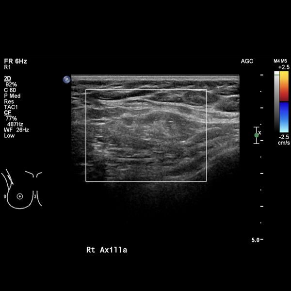 File:Normal breast mammography (tomosynthesis) and ultrasound (Radiopaedia 65325-74354 Right breast 18).jpeg